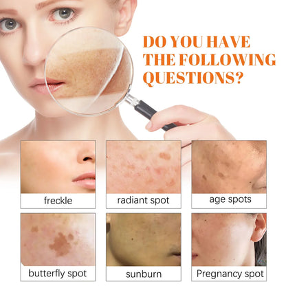Whitening Freckle Cream Melanin Blemish Remover Lighten Pigmentation Melasma Removal Whiten Nourish Dark Spot Corrector Cream