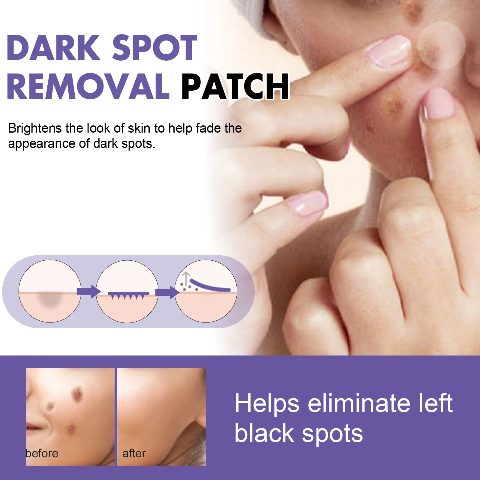 Spot-removing patches - for lightening facial dark spots, chloasma, pigmentation and melanin; moisturizing skin, spot patches